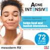 Mesoderm RX Acne Patch - Hydrocolloid Acne Pimple Patch for Zits and Blemishes, Spot Treatment Stickers for Face and Skin, Vegan and Cruelty Free (72 Count)