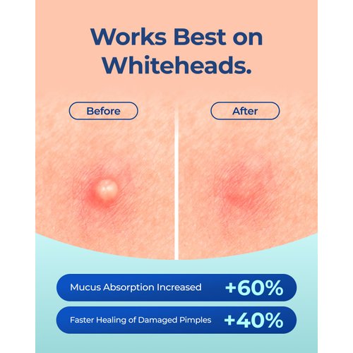 POINTMASS Pimple Patches for Face: 2 Size 308 Dots Invisible Hydrocolloid Acne Patch for Covering Zits and Blemishes, 0.1mm Ultra Thin Acne Spot Tea Tree Oil and Salicylic Acid