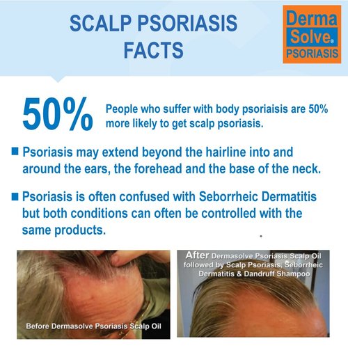 Dermasolve Scalp Psoriasis Medicated Shampoo & Conditioner (2-pack) Naturally Heals Dandruff Seborrheic Dermatitis Itchy Flakey Inflamed Skin & Provides Soothing Moisturizing Relief - Two 8 oz bottles