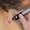 Skin Clinic Freeze Point for Warts and Skin Tags