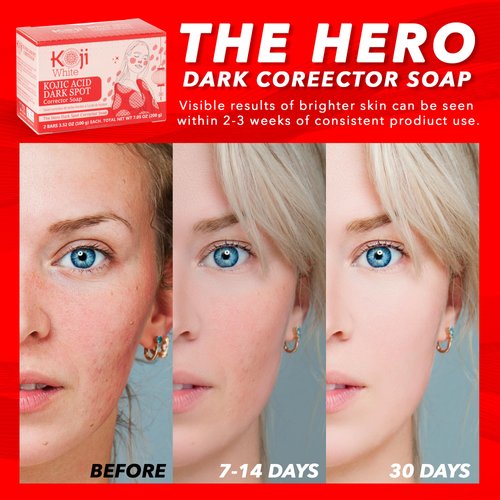 Koji White 4% Kojic Acid Dark Spot Corrector Soap For Exfoliating & Moisturizes with Vitamin C, Licorice Root Extract, Hydrating & Even Skin Tone Cleansing Bar for Face & Body, Vegan, 3.52 Oz (2 Bars)