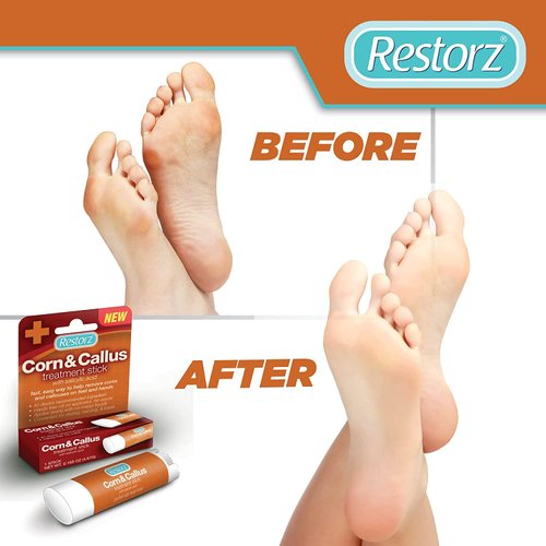Restorz Corn and Callus Remover Stick with Salicylic Acid (1 Pack) - No Mess Ointment Applicator for Gentle Removal/Portable & Travel Size Tube/Fast Acting Support for Skin, Hands, Feet & Toes