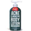 TreeActiv Acne Eliminating Body Lotion, 8 fl oz, Salicylic Acid Lotion, Salicylic Acid Body Acne Treatment, Back Acne Treatment Cream for Women and Men, Acne Lotion for Body, Zit Cream with 2000+ Uses