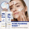 Acne Foaming Face Wash with 10% Benzoyl Peroxide - Maximum Strength Antibacterial Cleanser for Acne Face Wash and Body Cleanser - Treats Acne, Oily Skin, and Deep Pore Cleansing - 5.5 oz
