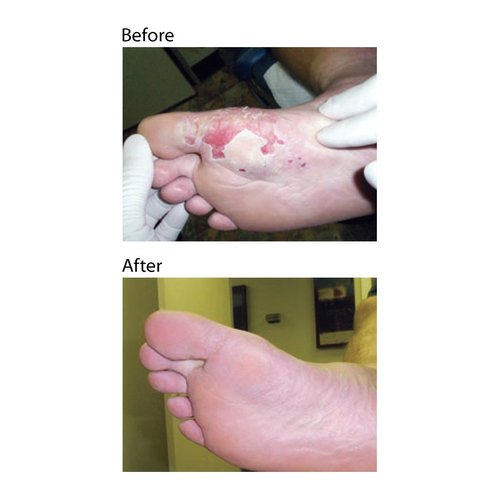 Dr. Nordyke's Wound Honey New Zealand Manuka Honey for Infections,Burns,Cuts and Scars (80g)