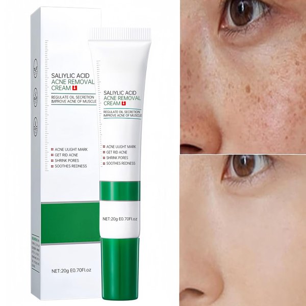 Salicylic Acid Acne Treatment, Dark Spot Remover for Face - Crema Para Manchas Oscuras En La Cara, Crema Blanqueadora Para La Cara, Cremas Para Quitar Manchas De La Cara