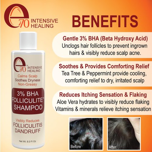 Folliculitis Treatment Clarifying Shampoo with Salicylic Acid to Remove Build Up, For Normal to Oily Scalp. Prone to Folliculitis, Dandruff, Itchy & Flaky Scalp, Seborrheic Dermatitis Paraben-Free.