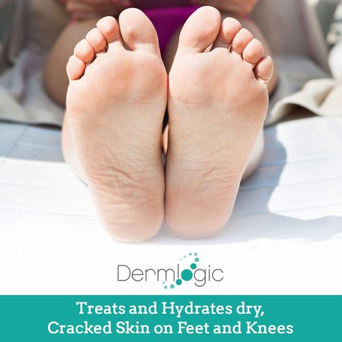 Keratosis Pilaris Treatment- Get Rid of KP, Bumps & Body Acne. 12% Lactic Acid Lotion. Moisturizing Repair Cream Smooths Rough, Dry, Cracked, Bumpy Skin & Redness.