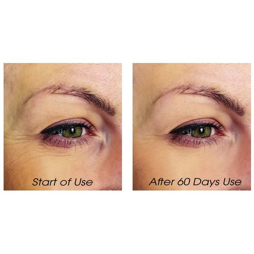 Lycopene Skin Care - Total Eye and Lip Treatment - Under Eye Circle Reducer and Wrinkle Eraser Serums