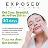 Exposed Skin Care Acne Treatment Serum Step 3 – Quickly Reduces Pimple Size and Redness - 12 Hour Spot Treatment - 3.5% Benzoyl Peroxide, Natural Green Tea & Tea Tree Oil