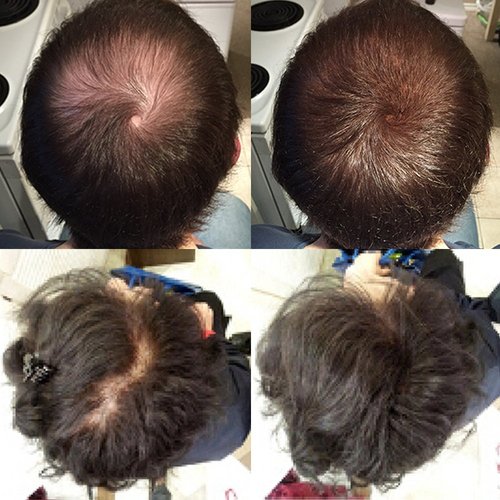 Nor1 Keratin Hair Building Fibers: Hair Fiber Filler and Thickener for Men and Women - Cover Up and Concealer for Thinning Areas or Minor Bald Spot - Thicker, Fuller Hair in Seconds - 25 grams, Black