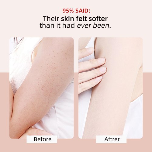 KP Bump Eraser Body Scrub with 10% AHA BHA Ingrown Hair Keratosis Pilaris Razor Bump Treatment Exfoliating Body Scrub Exfoliator Exfoliant Face Scrub for Strawberry Leg Pre-shaven Blackhead 4.23OZ