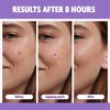 FreeGo Magnesium Acne Patch: Innovative Treatment for Acne, Dark Spots, Blemishes, and Cystic Acne - Patented & Clinically Tested Spot Solution (MEDIUM 8 PCS)