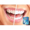 Whitelabs At Home Professional Teeth Whitening Kit