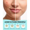 Acne Patch Pimple Patch, 4 Sizes 280 Patches Acne Absorbing Cover Patch, Hydrocolloid Invisible Acne Patches For Face Zit Patch Acne Dots Tea Tree, Calendula Oil - 2 Pack