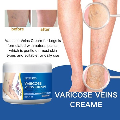 Uioecn 2Pcs Varicose Veins Cream, Skin Cream for Legs, Spider Varicose Veins ReliefCream
