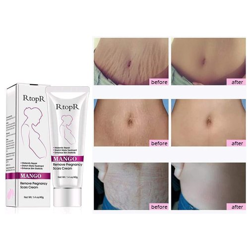 RtopR Mango Stretch Marks and Scar Cream -Stretch Marks and Scar Removal Cream for Pregnancy - Best Body Moisturizer-40g
