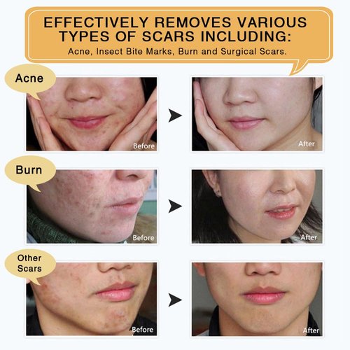 3 Pack Scar Removal Cream - TCM Scar Cream for Surgical Scars, Acne Skin Care Cream, Acne Treatment Cream for Scars, Burns, Stretch Marks, Acne Spots