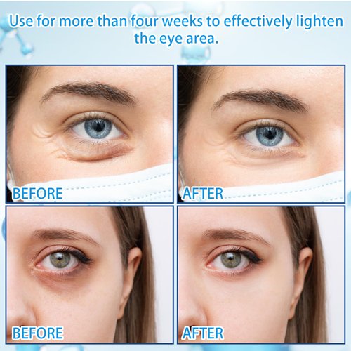 5% Caffeine Eye Serum with 360° Massage Rollerball Topper,Caffeine Eye Cream for Dark Circles,Wrinkles,Puffiness and Fine Lines,Under Eye Roller Cream Eye Bags Treatment for Women and Men