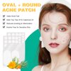 Acne Patches for Face (80 Count) , Round+Oval Five Sizes Pimple Patches Hydrocolloid Zit Patches For Face, Absorbing Hydrocolloid Spot Treatment Fast Healing, Blemish Cover, Hydrocolloid Acne Patch