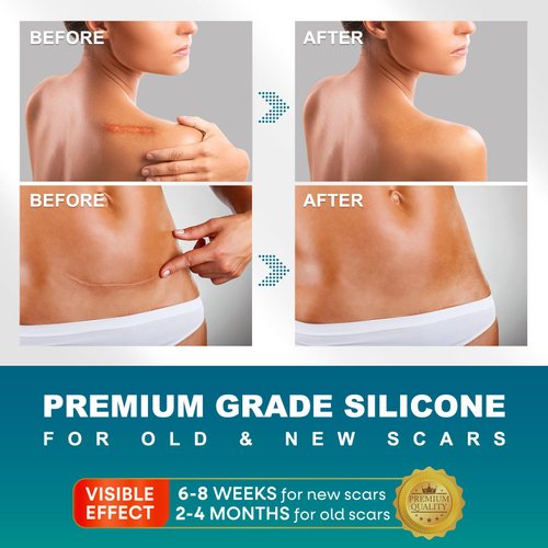 Silicone Scar Sheets, Silicone Scar Tape(1.6"x 120" Roll-300CM), Silicone Tape for Scars, Scar Tape for Surgical Scars, Silicone Scar Strips for C-Section, Tummy Tuck, Keloid, and Surgical Scars