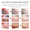 Acne Treatment Face Cream,Acne Spot Treatment for Face & Acne Dots,Natural Herbal Ingredients Professionally Remove Acne Marks,For Teens & Adults Anti-acne Moisturizer Pimple Cream