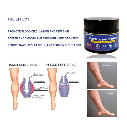 BERVEAL Varicose Veins Cream, Spider Veins Repair Cream, Improve Blood Circulation, Spider Varicose Vein Treatment Cream For Legs, Itching of Legs (1.76 OZ) (1)