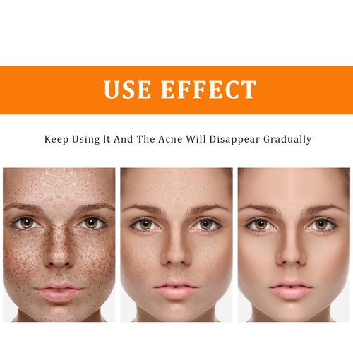 Toner for Dark Spots Turmeric Dark Spot Corrector Toner, Facial Toner for Acne Prone Skin, Dark Spot Remover for Face Hydrating Face Toner for Women, Moisturizing Toner Face for Dry Oily Skin- 4OZ