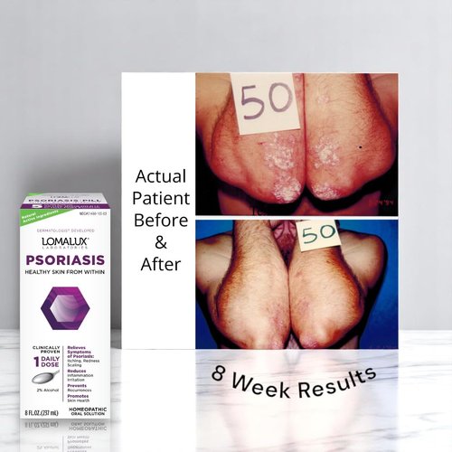 Loma Lux Psoriasis Clinically Proven, Dermatologist Developed Skin Clearing Natural Minerals, 8 Fl. Oz.
