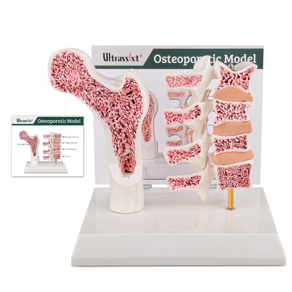 Ultrassist Osteoporosis Model, Human Vertebrae Anatomical Model for Teaching Demonstration with Study Card