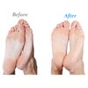 Emjoi Micro-Pedi 3D POWER Callus Remover (Twice as effective, with unique 3D Motion)
