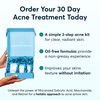 MDacne 3 Step Retinol Acne Kit - Retinol Cream 0.25%, Salicylic Acid Cleanser, Niacinamide Moisturizer - Plant-Based products for Hormonal Acne, Blemishes, and Wrinkles. 30 Day Complete Acne Care Kit