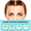 180 Counts Pimple Patches for Face Hydrocolloid Acne Patches for face Invisible Zit Patches for Face Pimple Patch Acne Spot Treatment Patch Blemish Patches Cover Patches Stickers
