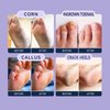 NOVAL Callus Remover for Feet Professional Callus Remover Gel - 8.8 Oz Powerful Extra Strength Gel Remove Hard Skins Heels and Soften Tough Callouses for Foot Spa Home Pedicure