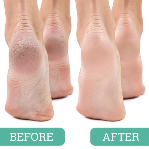 Maccibelle Salon Foot Pumice and Scrubber for Feet and Heels Callus and Dead Skins, Safely and Easily Eliminate Callus and Rough Heels (Pack of 12)