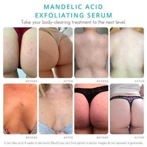 Body Clearing Serum [4 Fl Oz] Level 2 Acne Serum - Advanced Formula for Body Acne, Folliculitis, Back, Butt, Chest, Thighs, Shoulders - Mandelic Acid