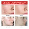 Wentoenapp 240 Pcs Star Pimple Patches,Pimple Patches for Face,Spot Stickers for Face and Skin Treatments and Masks, Pore Cleansing Strips