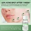 LANBENA Acne Spot Treatment Drying Lotion, Overnight Acne Treatment For Face, Precision Acne Serum, Dry Out Pimples, Blemishes, Zits And Clean Pores, 0.42 Fl Oz