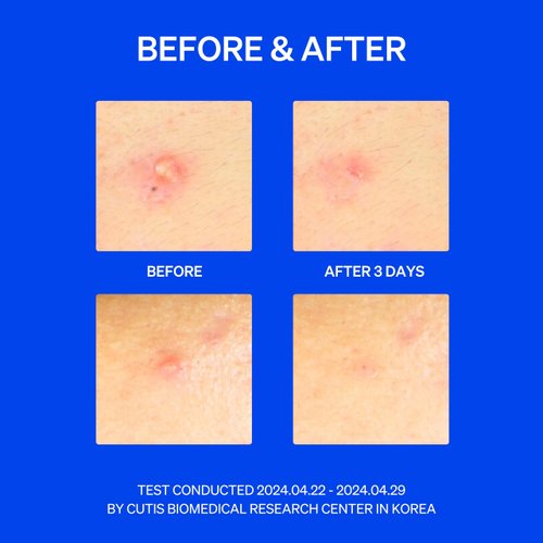 KNEMO Right Away Thincognito Invisible Spot Patch - Absorbing Hydrocolloid Acne Patch for Face, Blemishes, Zits, Breakouts Spot Treatment for Skin Care, 2 Sizes (42 Count)