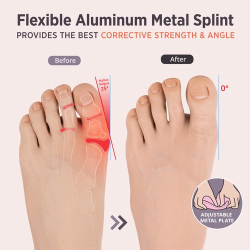 PEDIGOO Bunion Corrector for Women 2pc, Non-Slip Bunion Toe Separator, Hallux Valgus Relief for Day/Night Support (Beige)