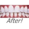 INSTANT WHITE SMILE optimized 30cc GELL ONLY syringes (NO TRAYS) 36% Professional Strength Carbamide Peroxide Teeth Whitening Gel only with Shade Card