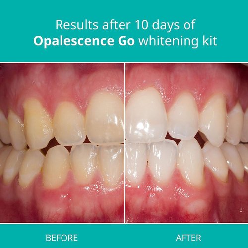Opalescence Go 10- Prefilled Teeth Whitening Trays Kit- 10% Hydrogen Peroxide - (10 Treatments) - Mint Made by Ultradent Products. Go Teeth Whitening Kit -Mint- GO10-5193-1