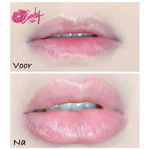 CANDYLIPZ Lip Plumping Tool | 100,000 Orders Remarkable Milestone Reached | Travel Size Lip Plumper | One Size Fits All Fuller Lips Instantly | Sexy Pout | Double-Lobed Style