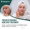 TreeActiv Invisible Salicylic Acid Cystic Acne Treatment For Face Original Formula, 0.5 fl oz, Acne Face Cream, Acne Spot Treatment for Face & Body, Acne Clearing Cream Moisturizer for Teens & Adults