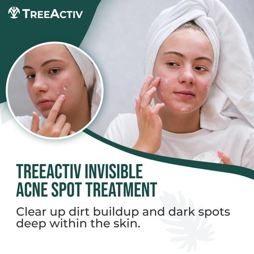 TreeActiv Invisible Salicylic Acid Cystic Acne Treatment For Face Original Formula, 0.5 fl oz, Acne Face Cream, Acne Spot Treatment for Face & Body, Acne Clearing Cream Moisturizer for Teens & Adults