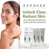 Exposed Skin Care Expanded Acne Treatment Kit - Includes Salicylic Acid Face Wash, Clearing Tonic, Treatment Serum with Benzoyl Peroxide, Clear Pore Serum, Moisture Complex - Made for All Skin Types