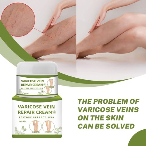Varicose Veins Cream, Spider Veins Repair Cream, Varicose & Spider Veins Leg Cream, Varicose Vein Treatment Cream for Legs (50g)