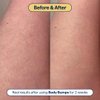 Remedy for Body Bumps – Treatment for Keratosis Pilaris (KP) and Textured, Crepey Skin with Urea, Lactic Acid, and Retinol -– Smoothing Body Moisturizer Lotion – By Dermatologist Dr. Shah