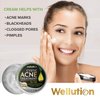 Wellution Cystic Acne Treatment Cream - Natural Pimple and Scar Remover with Tea Tree Oil - Effective Overnight Face Treatment for Acne Spots, Pimples and Scars - 1oz