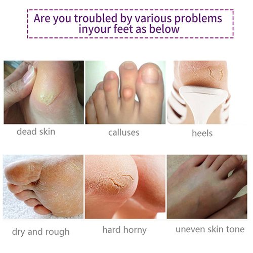 Foot Peel Masks for Dry Cracked Feet 5 Pack,Exfoliating Foot Mask, Natural Exfoliator for Dead Skin, Callus, Repair Rough Heels for Men Women,Make your Foot Baby Soft in 7 Days, AlIVER (4" - 12")